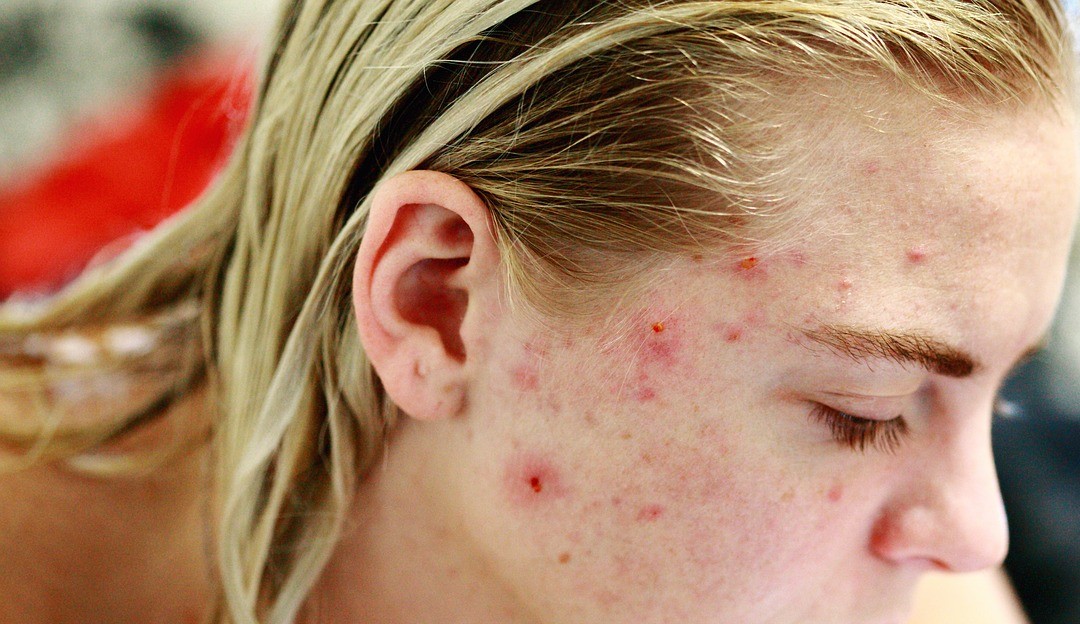 Dicas para evitar o aparecimento das acnes