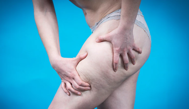 Lipedema: Entenda mais sobre a doença que causa inchaço e acúmulo de gordura no corpo