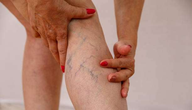 Calor aumenta incômodo com varizes: saiba como amenizar sintomas