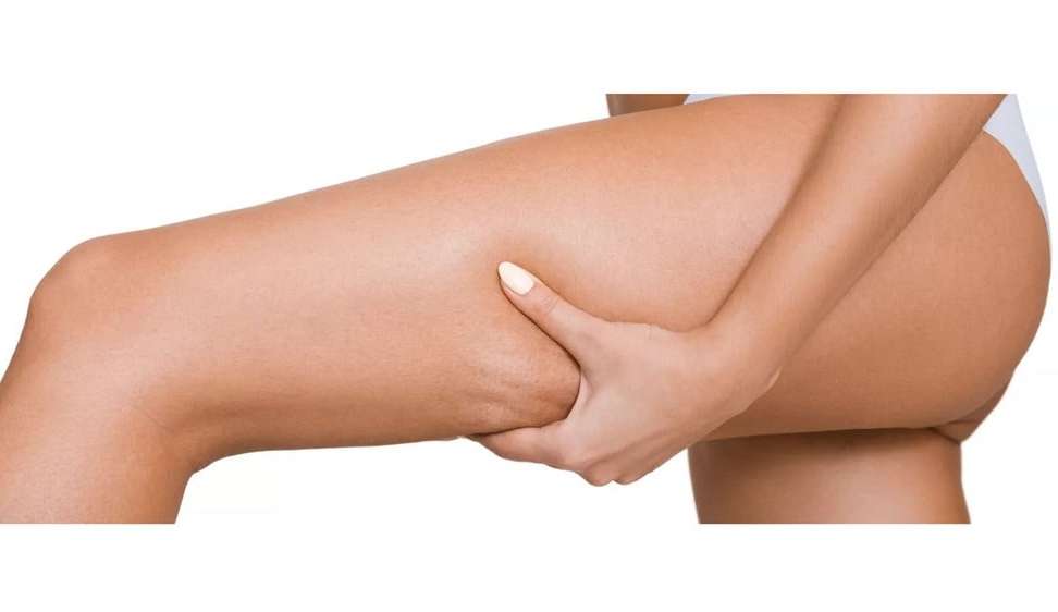 Eletroestimulação muscular ajuda a perder celulite e ganhar massa muscular