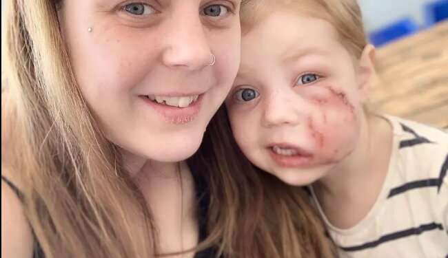 Uma menina de apenas 4 anos foi atacada por um Bulldog e levou mais de 40 pontos