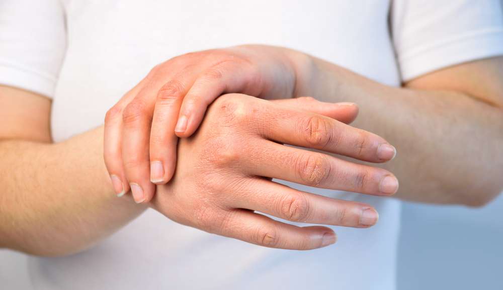 Alergia ao frio: saiba como tratar, conhecer os sintomas e prevenir