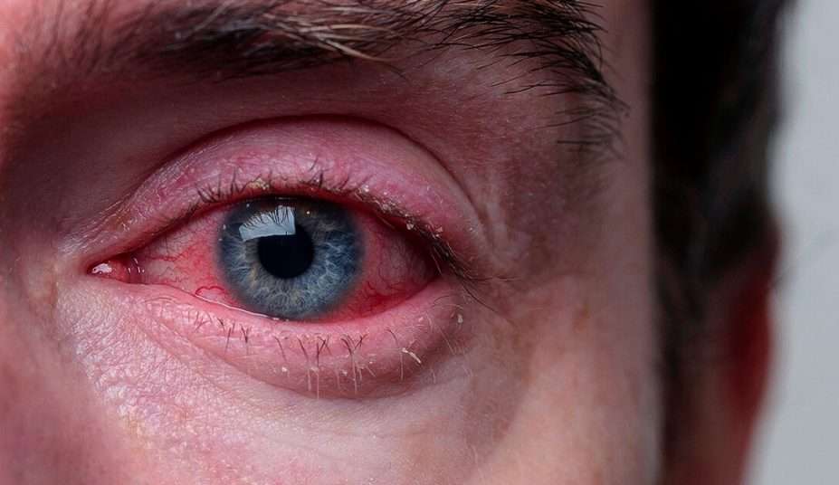 Arcturus: Conheça a variante da Covid-19 que pode ser confundida com conjuntivite