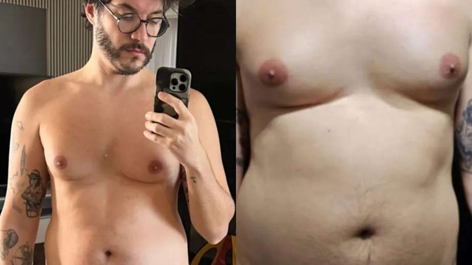 Eliezer tem diagnóstico comprovado de ginecomastia, doença mamária