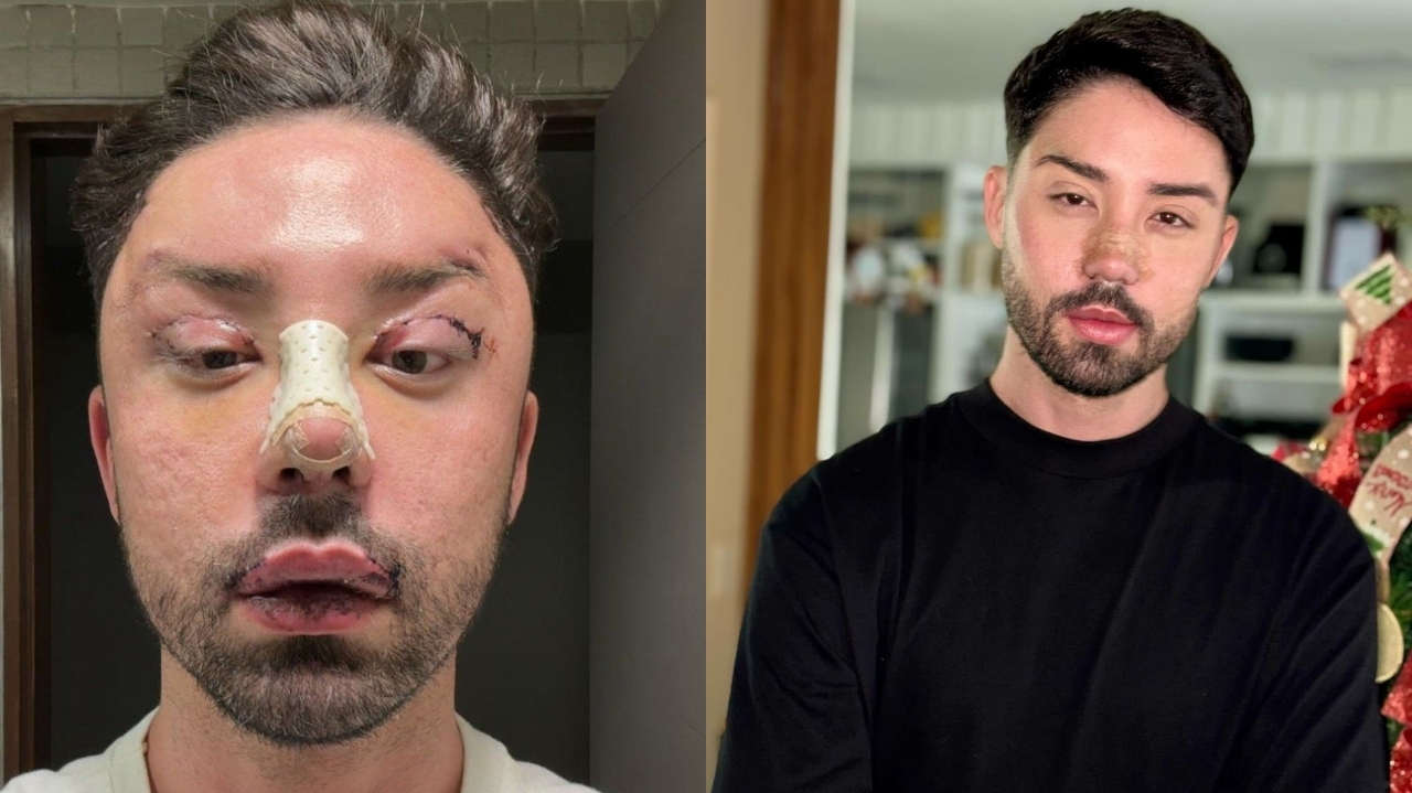 Rico Melquiedes mostra resultados após procedimento cirúrgico