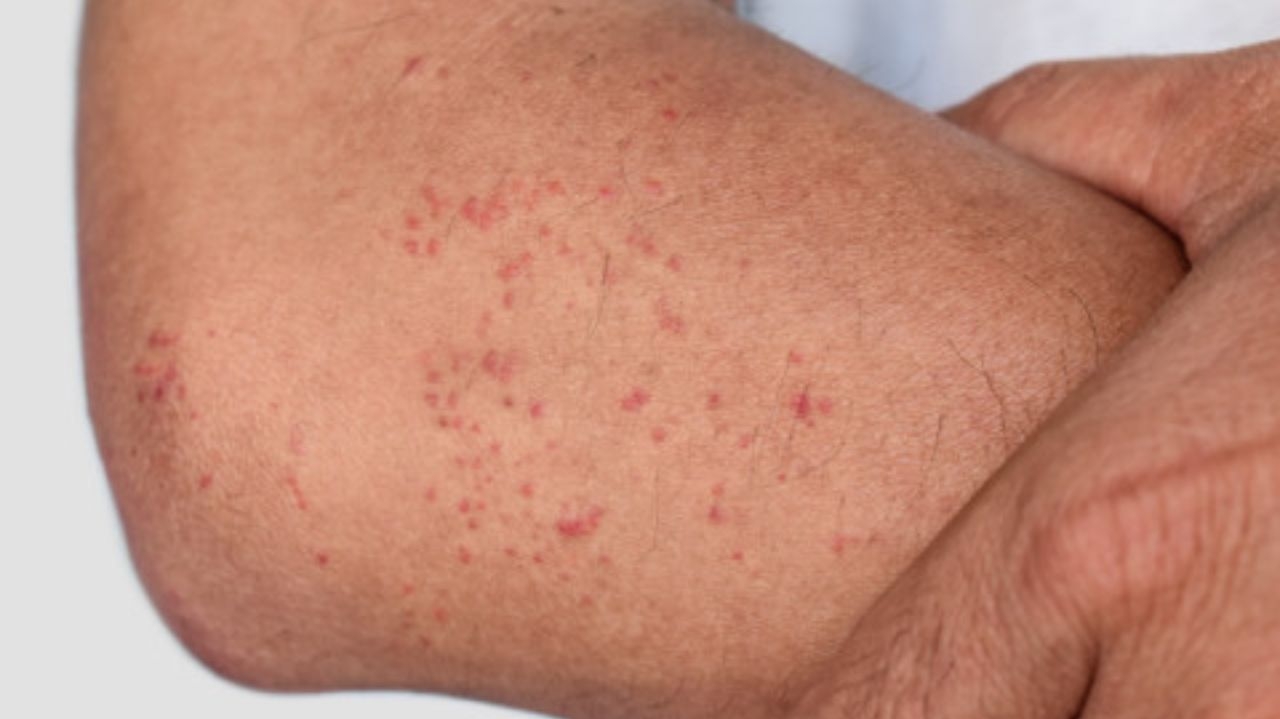 Infectologista explica como diferenciar dengue e Covid por meio dos sintomas