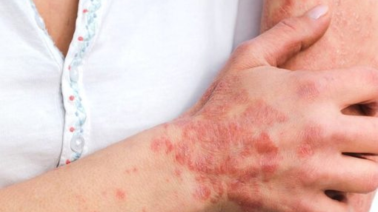 Dengue hemorrágica: saiba como identificar os sintomas