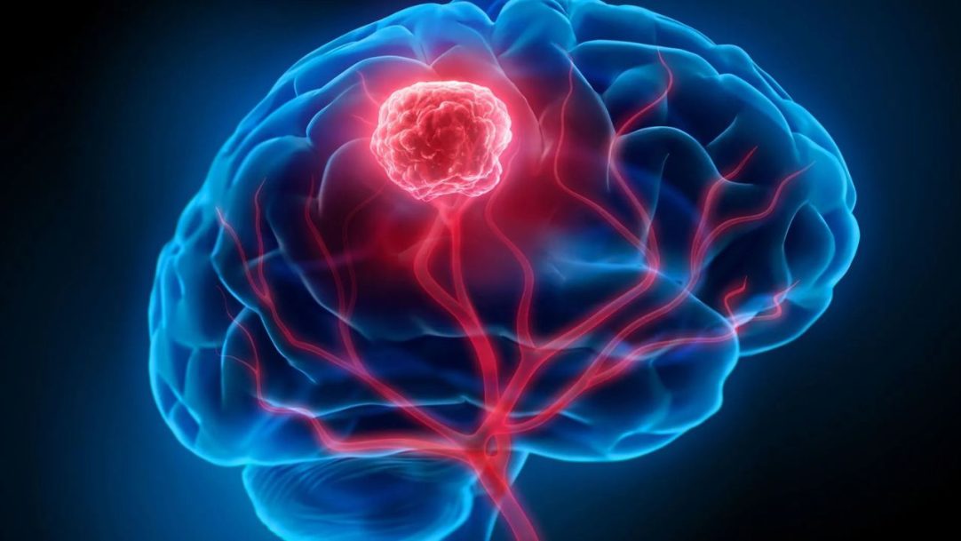 Medicamento para tratar tumores cerebrais é aprovado pela Anvisa